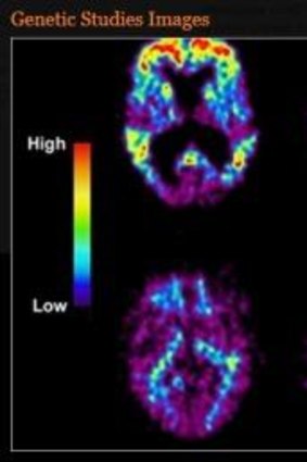 Contrast: Scans of an Alzheimer's sufferer's brain, top, and a normal brain, below. 