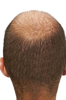 Male baldness: most men will experience it sooner or later.