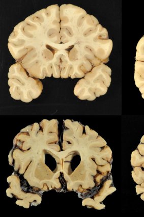 This combination of photos provided by Boston University shows sections from a normal brain, top, and from the brain of former University of Texas football player Greg Ploetz.