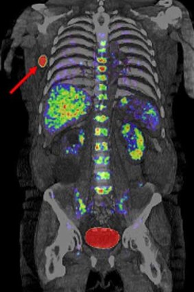 A PET scan of a patient's body. The red areas indicate the tracer.