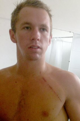 Jake Whitehead shows the wounds he received in the Bounty brawl. Photos courtesy of <em>The Daily Advertiser </em>.