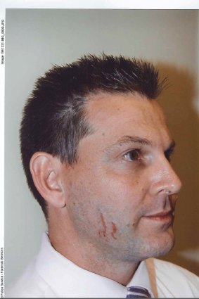 Scratches on Gerard Baden-Clay's face  provided crucial evidence during his murder trial.