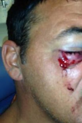 Eye for an eye: Mark Morlock in hospital after he was attacked at Gold Coast's Greenmount.