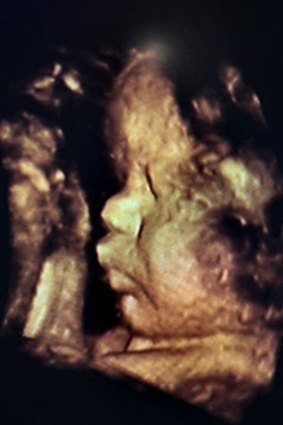 An ultrasound picture of a foetus in the third trimester.