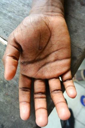 Demianus Gobay says his hand was burnt with a cigarette as a punishment for breaking rules.