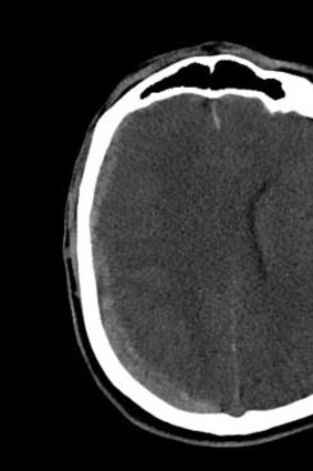 A CT scan of the brain. The bottom left shows where blood built up after his brain collided with the inside of his skull.