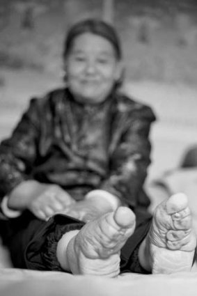 An image showing Su Xi Rong's unwrapped feet.