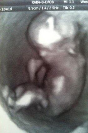 An image of the baby at a 12-week scan, as posted on Facebook by Amy Zempilas