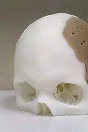 Oxford Performance Materials built a skull implant, like this one, for a US man.