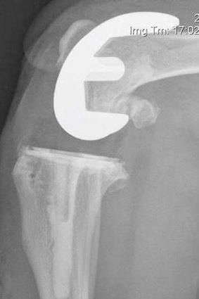 Cobalt-chromium fitting: A knee replacement X-ray.