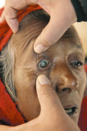 Open wide …  a woman with very visible cataracts is prepared for surgery at Manpur.