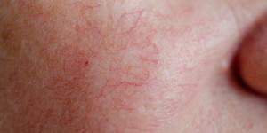 Spider veins often appear on the face,but can occur anywhere on the body.