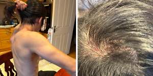 Hong Kong protestor Bob says hair was ripped from his scalp when he was beaten on the grounds of the Chinese consulate in Manchester,England,on Sunday,16 October,2022.