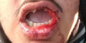 A Menulog rider lost several teeth after he was allegedly assaulted in Randwick last month by a stranger shouting racial epithets.