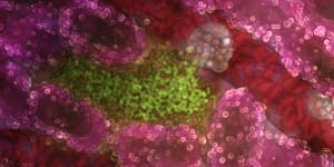 Illustration of liver cells (pink) infected with a malaria parasite (green). Malaria lurks and multiplies in the liver before attacking red blood cells.