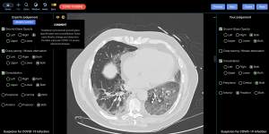 A lung CT showing indications of severe COVID-19.