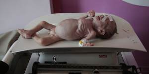 A malnourished boy,Maher Ahmed,is placed on a scale Al-Sabeen hospital in Sanaa,Yemen.
