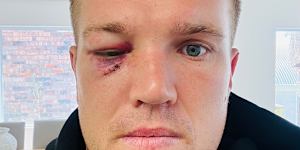 Jake Trbojevic’s right eye was still closed over on Sunday.