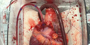The donor heart reanimated and beating after circulatory death the ex vivo perfusion rig. 