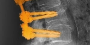 Spinal fusion involves the joining of two or more vertebrae.