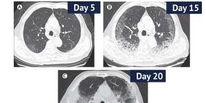CT scans from a 77-year-old man with COVID-19 in China over 10 days,showing ground-glass opacity of the lungs and lesions. The man died 10 days after the final scan.