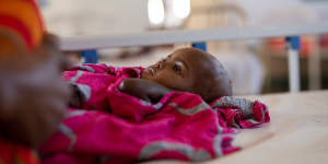 Amira Jimale is 17 months old and is receiving treatment for malnutrition at Burao General Hosplital in Somaliland.