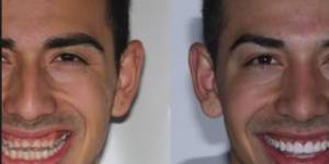 Jono achieved a celebrity smile thanks to porcelain veneers and invisalign.