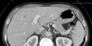 A CT scan shows an unsuspected liver nodule (dark area in the green ring),which is harmless.
