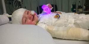 Charlie Burgess was only 11 months old when he suffered burns after pulling a deep fryer off the kitchen bench.