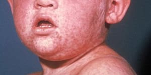 Measles alert after infected man visits Brisbane airport and shops