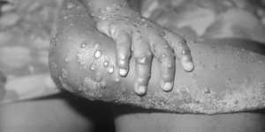 Monkeypox-like lesions on the arm and leg of a girl in Liberia in 1971. 