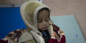 Guldana,2 and malnourished,sits on a bed in the Indira Gandhi hospital in Kabul,Afghanistan,on Monday.
