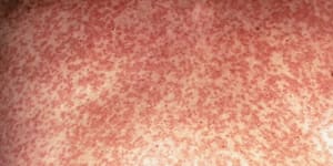 Two more measles cases in Sydney