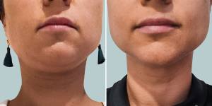 Before and after images promoting Ulfit treatments on the chin and neck.