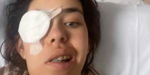 Jade suffered an ulcer on her eye after her meningioma was removed.