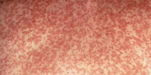 Measles warning after a second infected man arrives in Sydney