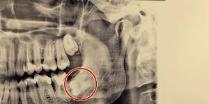An impacted wisdom tooth. 
