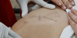 Everything you need to know before having a tattoo removed
