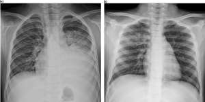 Collection of radiographs show the effects of mycoplasma pneumoniae on the lungs of children. Source:Cho et al (2019)