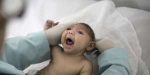 A baby with microcephaly,a defect linked to the Zika virus,in Brazil.