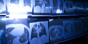 X-rays showing the effects of silicosis on the lungs.