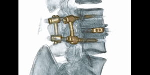 Blicavs spent more than 12 months doing rehabilitation.