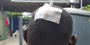 A photograph showing an injury allegedly sustained in the Good Friday incident at Manus Island regional processing centre.