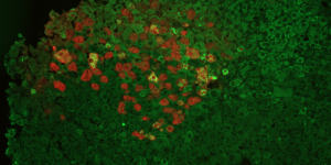 Liver cells treated by gene therapy during Lisowski’s research.