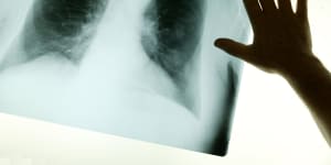 The government has committed to tackling Australia's occupational lung disease crisis.