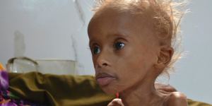 Salem,5,who suffers from malnutrition,sits on a bed at a hospital in the port city of Hodeidah,southwest of Sanaa,Yemen,in September. 