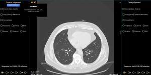 A lung CT showing no sign of COVID-19. 