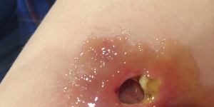 Madeleine Danaher's ulcer.