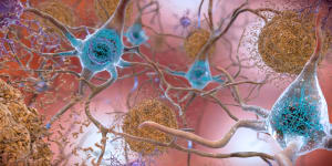 Abnormal levels of beta-amyloid protein form plaques (brown) that disrupt cell function and abnormal levels of tau protein form tangles (blue) harming communications between neurons in an Alzheimer’s affected brain.