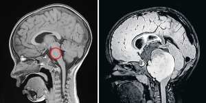 The pons circled on a healthy child’s brain scan (left),shown alongside the brain of a child with diffuse intrinsic pontine glioma (DIPG).